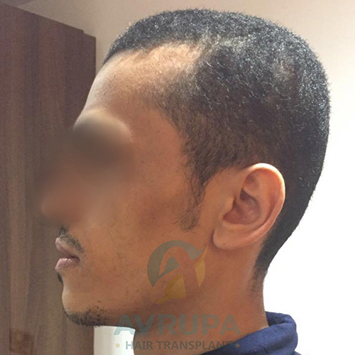 CASE (92): Before & After Goatee Transplant in Turkey - 1950 Grafts ...