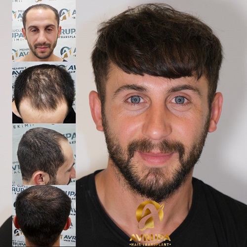 Before After - Avrupa Hair Transplant clinic