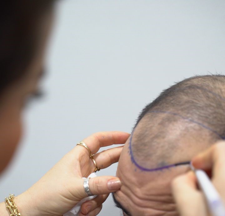 hairline-design-Turkiye.jpg