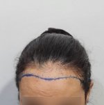 female hair transplant - hairline design.jpg