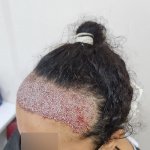 immediately after  female hair transplant.jpg