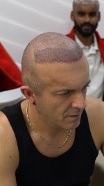 celebrity hair transplant in Turkey- Avrupa Hair transplant (2).jpg