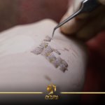 celebrity hair transplant in Turkey- Avrupa Hair transplant (3).jpg