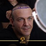 celebrity hair transplant in Turkey- Avrupa Hair transplant (4).jpg