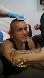 celebrity hair transplant in Turkey- Avrupa Hair transplant.jpg