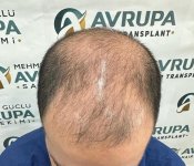 hair-transplant-result (2)-ClinicAdvisor.jpg