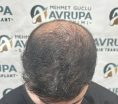 hair-transplant-result (4)-ClinicAdvisor.jpg
