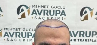 hair-transplant-result-ClinicAdvisor.jpg