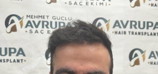hair-transplant-result (3)-ClinicAdvisor.jpg