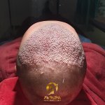 Before a hair transplant in Turkey..jpg