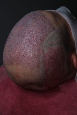 Hair transplant in Turkey - May 2024 (2).jpg